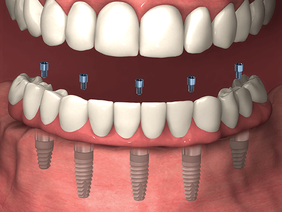 Fixed-Denture-1 Fixed dentures image
