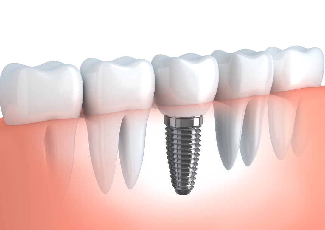 dental-implant-1 Dental implant image